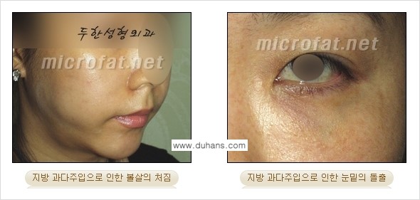 [두한성형외과 "미세지방이식"] - [지방이식 부작용 교정 정보 ①] 관련 이미지 4