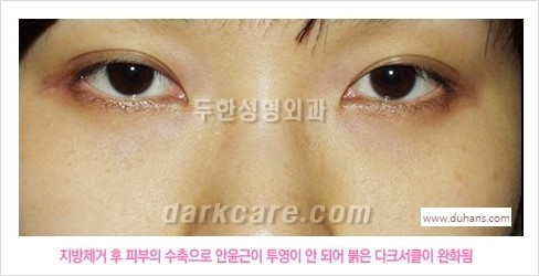 [두한성형외과 경쟁력 눈밑성형] - [눈밑 안와지방 돌출의 무통마취 무흉터 눈밑지방제거 안내] 관련 이미지 6