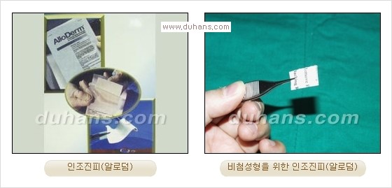[두한성형외과 경쟁력 코성형] - [코성형을 위한 알로덤(슈어덤) 수술, 실리콘 수술 안내] 관련 이미지 1