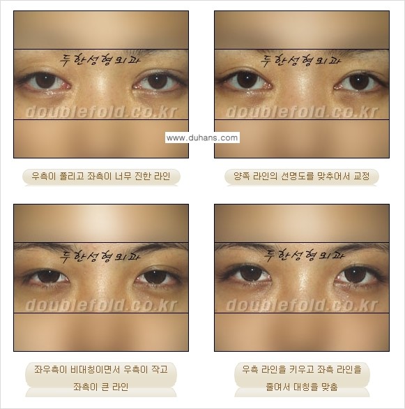 [두한성형외과 경쟁력 눈성형] - [비대칭(짝짝이) 쌍꺼풀 라인 교정 안내 ②] 관련 이미지 6