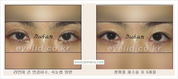 [두한성형외과 경쟁력 눈성형] - [안검하수와 몽고주름에 대한 자주하는 질문과 답변] 관련 이미지 5