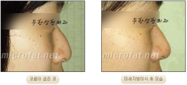 [Duhan Plastic Surgery Facial Fat Grafting] - [Fat Grafting Rhinoplasty] image 10