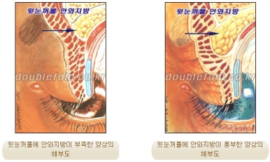 [두한성형외과 쌍커풀수술] - [쌍꺼풀지방이식] 관련 이미지 5