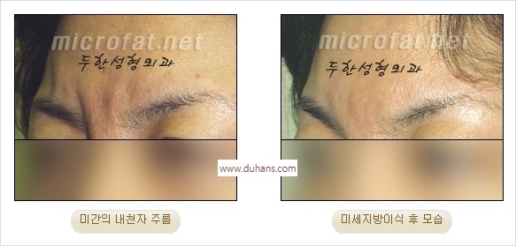 [두한성형외과 경쟁력 동안성형 리더] - ​[미간주름, 이마주름, 안검성형, 이마거상술, 눈썹거상술] 관련 이미지 22