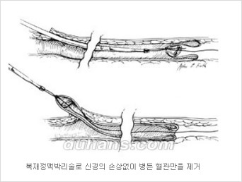 [두한성형외과 정맥류] - [하지정맥류, 정맥확장증, 혈관확장증] 관련 이미지 14