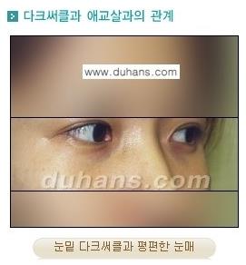 [두한성형외과 경쟁력 눈밑성형] - [눈밑 애교살을 위한 미세지방이식 ①] 관련 이미지 3