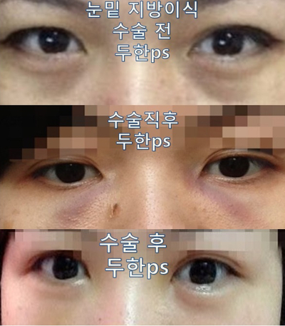[두한성형외과 다크서클] - [다크서클 콜펫지방이식] 관련 이미지 39