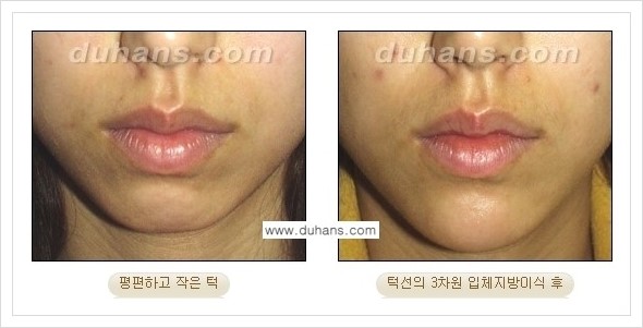 [두한성형외과 경쟁력 미세지방이식] - [아름다운 얼굴선 - 무턱, 오목턱, 비대칭턱 지방이식 안내] 관련 이미지 3