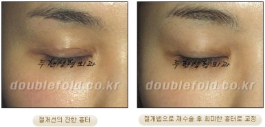 [두한성형외과 쌍커풀재수술] - [심한 소세지눈, 두줄따기, 쌍꺼풀 흉터] 관련 이미지 44