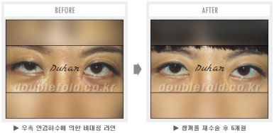 두한성형외과 쌍커풀 재수술 - 짝눈 눈매교정, 가성 안검하수 교정과 뒤밑트임 관련 이미지 57
