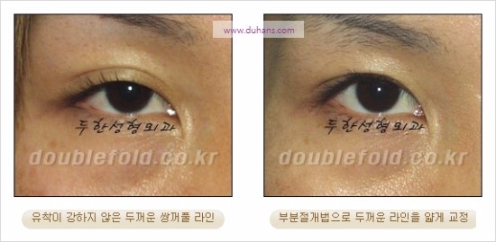 [두한성형외과 경쟁력 눈성형] - [쌍꺼풀 재수술에 대한 최선의 대안 제시] 관련 이미지 30