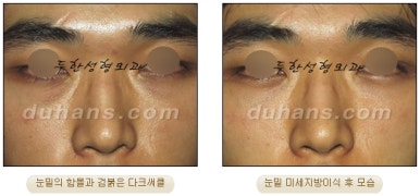 두한성형외과 눈밑성형 - 눈밑지방제거, 눈밑주름, 눈밑지방재배치 관련 이미지 77