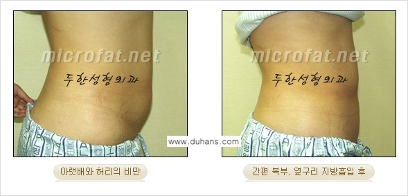 [두한성형외과 겨울엔 간편 지방흡입] - [복부, 뱃살, 아랫배, 옆구리 지방흡입 도전!] 관련 이미지 11