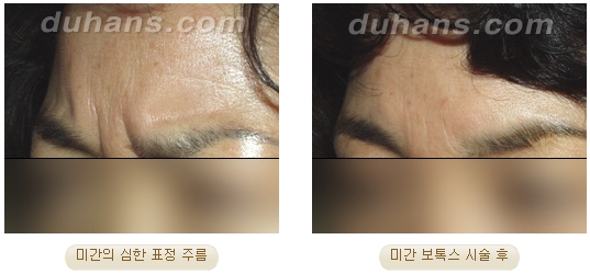 ​[두한성형외과 안티에이징] - [보톡스, 필러, 지방이식을 이용한 주름개선] 관련 이미지 8