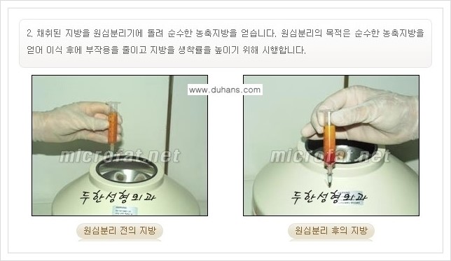 [두한성형외과 경쟁력 미세지방이식] - [귀족수술과 인디언밴드 교정 안내] 관련 이미지 3