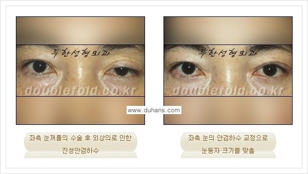 [두한성형외과 경쟁력 쌍꺼풀 재수술(극한 재수술)] - [안검하수(졸리운 눈매) 교정 안내 1.] 관련 이미지 9