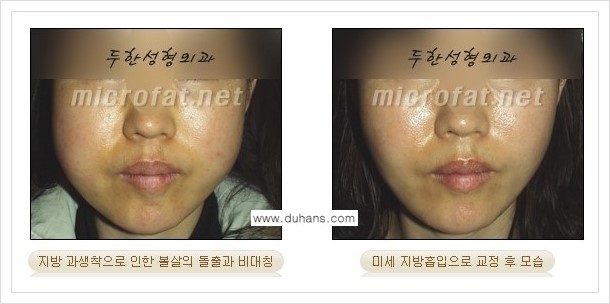[두한성형외과의 경쟁력 지방이식] - [볼살 지방이식 부작용 -  지방이식 후 과주입으로 인해 불룩해진 경우] 관련 이미지 4