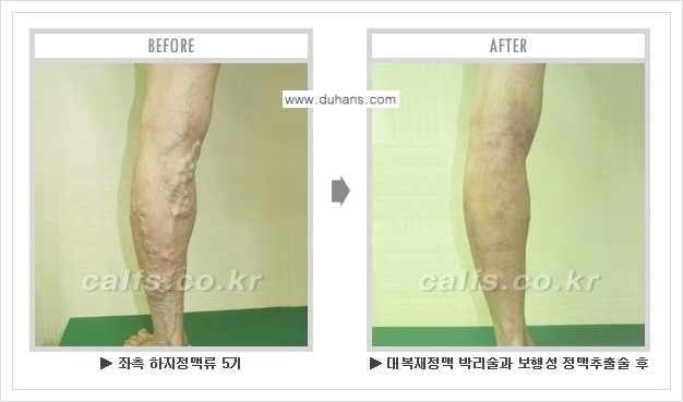 [두한성형외과 경쟁력 멀티종아리성형] - [하지정맥류 치료 안내] 관련 이미지 2