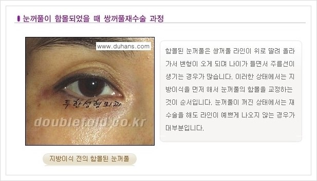 [두한성형외과 경쟁력 쌍꺼풀 재수술, 극한 재수술] - [쌍꺼풀 재수술의 과정 안내 2.] 관련 이미지 1