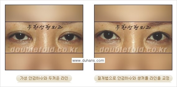 [두한성형외과 경쟁력 눈성형] - [안검하수 수술 방법] 관련 이미지 9