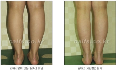 ​[두한성형외과 종아리수술] - [나에게 맞는 종아리성형방법] 관련 이미지 37