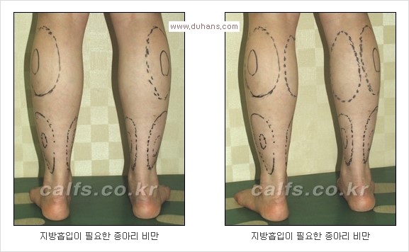 [두한성형외과 경쟁력 멀티종아리성형] - [종아리(다리) 비만 해결 방법 안내] 관련 이미지 2