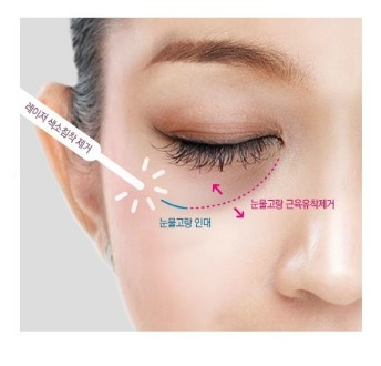 [두한성형외과 경쟁력 눈밑성형] - [Dr. 컬럼 "눈밑 지방재배치의 문제점"] 관련 이미지 1