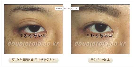 Dr. 컬럼 - 쌍꺼풀 재수술의 부작용을 최소화하는 극한 눈재수술 관련 이미지 5