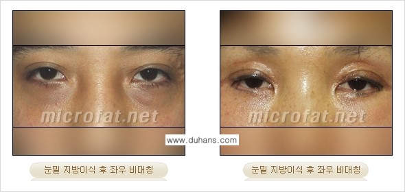 [두한성형외과 경쟁력 "미세지방이식"] - [미세지방이식의 잘못된 지식 1.] 관련 이미지 11