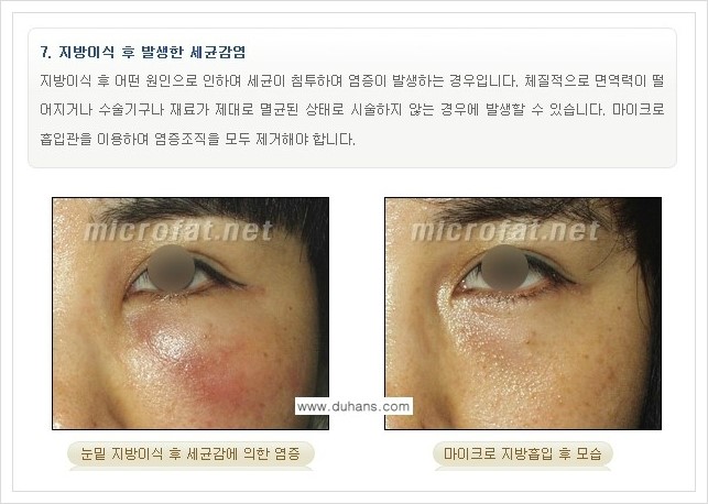 [두한성형외과 경쟁력 지방이식] - [지방이식 부작용 교정 안내 2.] 관련 이미지 14
