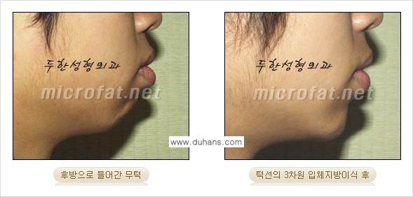 [두한성형외과의 경쟁력 미세지방이식] - [무턱교정 - 턱 미세지방이식 안내 2.] 관련 이미지 22