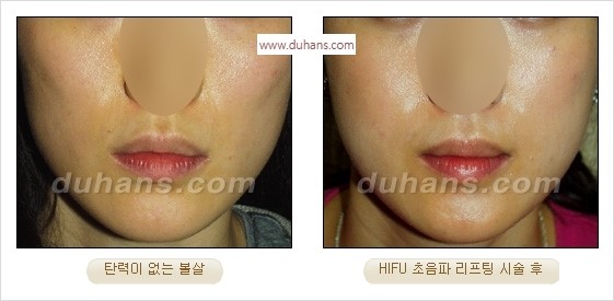 [두한성형외과 경쟁력 주름성형] - [간단하고 부작용 없는 자연스러운 주름제거 방법] 관련 이미지 34