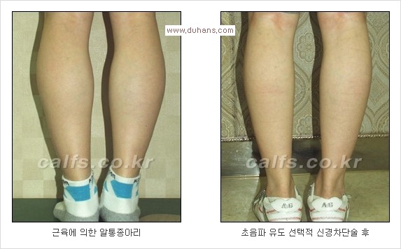 ⁠⁠[두한성형외과 경쟁력 종아리성형] - [굵은 다리의 모양과 원인에 따른 종아리성형 방법] 관련 이미지 14