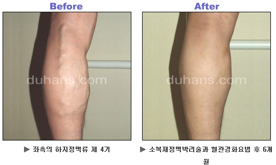[두한성형외과 정맥류] - [하지정맥류, 정맥확장증, 혈관확장증] 관련 이미지 22