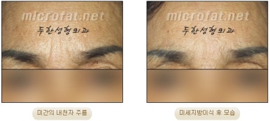 Duhan Plastic Surgery Wrinkle Improvement - Glabellar Horizontal Wrinkles, Glabellar Straight Wrinkles, Glabellar Wrinkle Surgery image 14