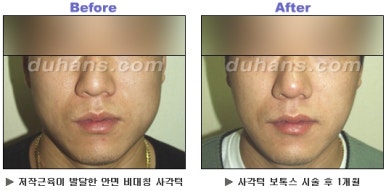 [Duhan Plastic Surgery Clinic Aesthetic Procedures] - [Square Jaw Botox] image 20