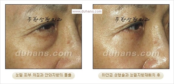 [두한성형외과 경쟁력 다크써클 교정] - [젊어 보이면서 개선된 인상을 주는 하안검 성형술] 관련 이미지 22
