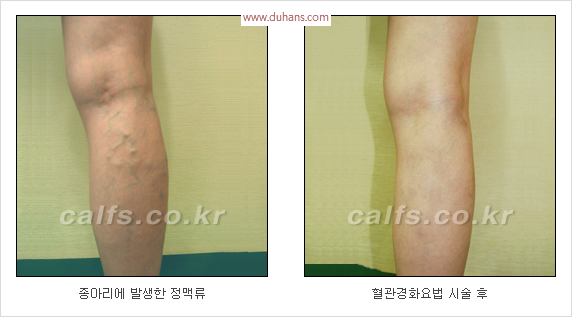 [두한성형외과 경쟁력 종아리성형 리더] - [종아리 성형 안내] 관련 이미지 20