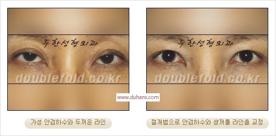 [두한성형외과 경쟁력 눈성형] - [안검하수(졸린눈매) 눈매교정 여러 가지 방법 안내] 관련 이미지 19