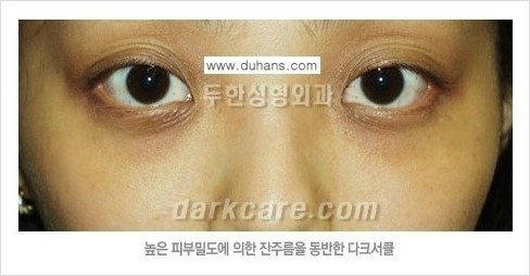 [두한성형외과 경쟁력 눈밑성형] - [눈밑 다크써클 원인 안내] 관련 이미지 9
