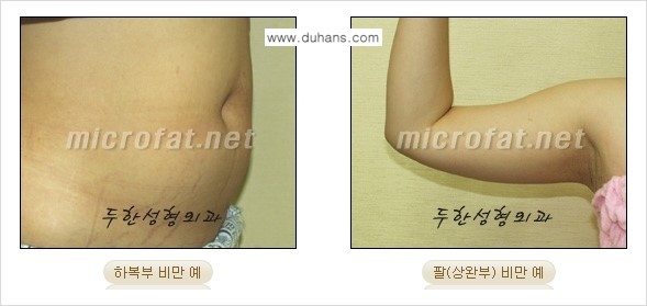 [두한성형외과 간편 지방흡입] - [복부(뱃살) 지방흡입 안내 ①] 관련 이미지 2