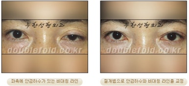 [Duhan Plastic Surgery Double Eyelid Revision Surgery] - [Ptosis, sausage eyelids] image 22