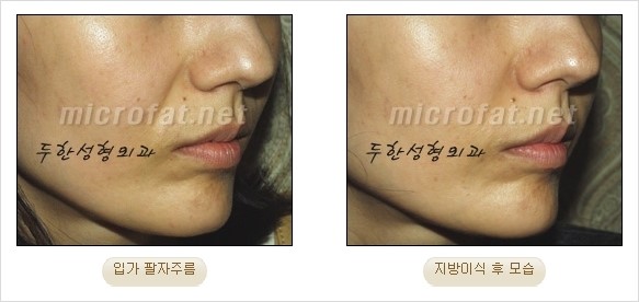 [두한성형외과 경쟁력 안티에이징 동안성형] - [주름이 깊은 푹~ 꺼진 입가 팔자주름 안녕!] 관련 이미지 24