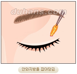 두한성형외과 지방제거 - 눈밑지방, 눈꺼풀지방제거 관련 이미지 6
