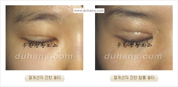 [두한성형외과 경쟁력 쌍꺼풀 재수술, 극한 눈재수술] - [절개법 수술후 쌍꺼풀 흉터선이 진한 경우의 교정 안내] 관련 이미지 1