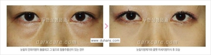 ​[두한성형외과 다크써클 치료] - [눈밑에 돌출이 있으면서 그 아래 함몰주름선이 있는 다크써클 증상] 관련 이미지 3