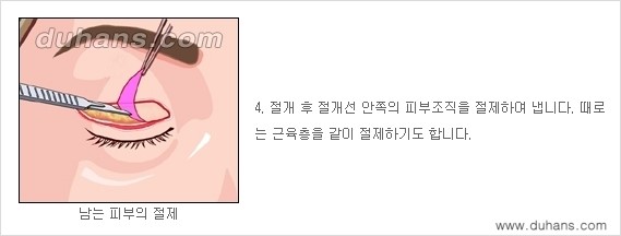 [두한성형외과 경쟁력 눈성형] - [상큼하고 환한 젊은 눈매 상안검성형(윗눈꺼풀 처짐) 안내] 관련 이미지 4