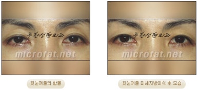 [Doohan Plastic Surgery Autologous Fat Grafting] - [Sunken Eye Fat Grafting] image 26