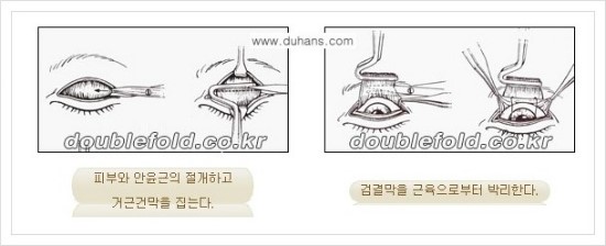 [두한성형외과 경쟁력 눈성형] - [극한 재수술, 함몰된 눈꺼풀 라인교정, 안검하수(졸리운 눈매)] 관련 이미지 93