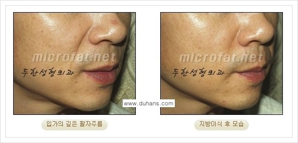 [두한성형외과 경쟁력 미세지방이식] - [입가주름, 팔자주름 교정 안내] 관련 이미지 15